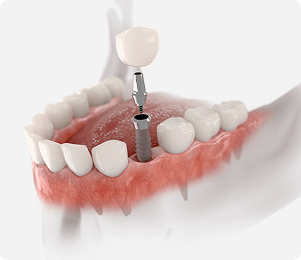 Trồng Răng Implant Là Gì? Quy Trình Như Thế Nào?