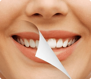 Tẩy trắng răng