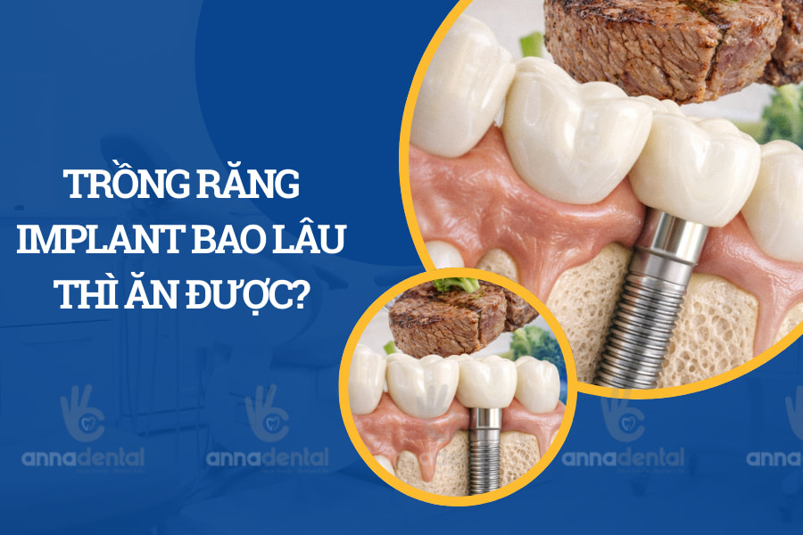 TRỒNG RĂNG IMPLANT BAO LÂU THÌ ĂN ĐƯỢC?