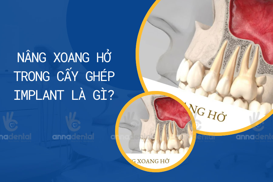 nâng xoang hở