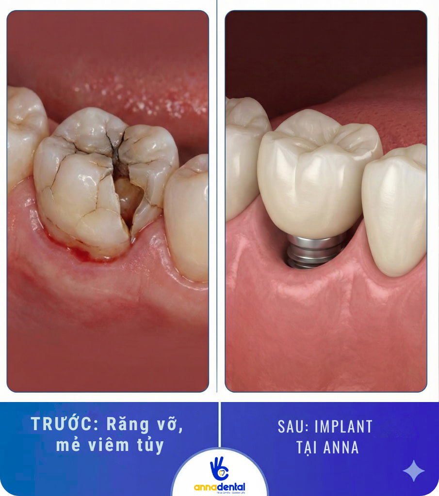 Răng sứt mẻ, gãy vỡ, viêm tủy,