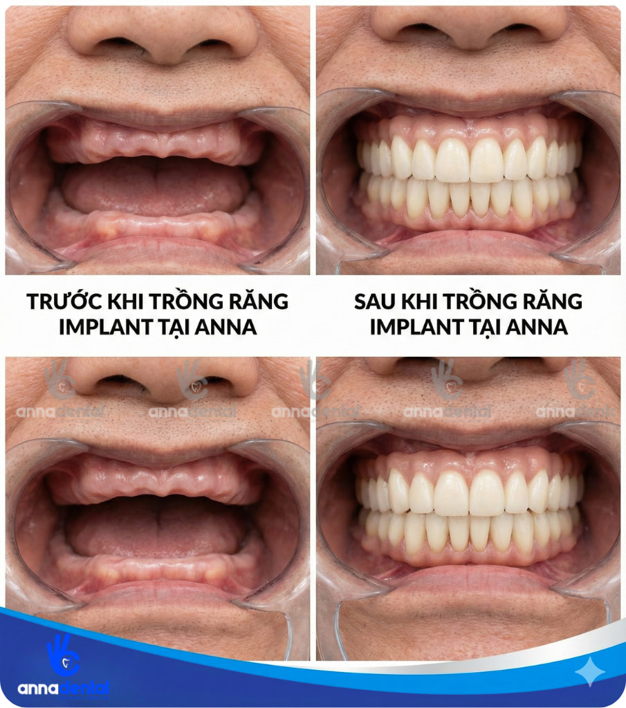 Mất toàn bộ răng cả hàm trên và hàm dưới