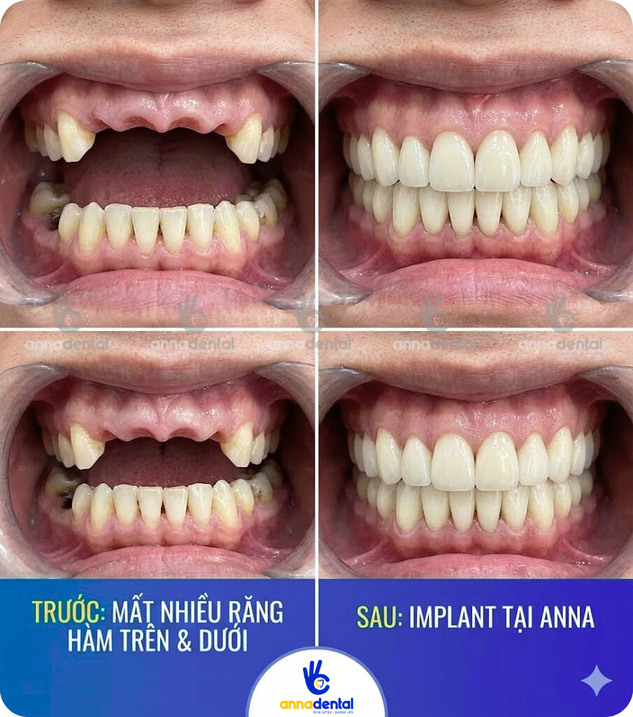 Mất nhiều răng hàm trên hoặc răng hàm dưới