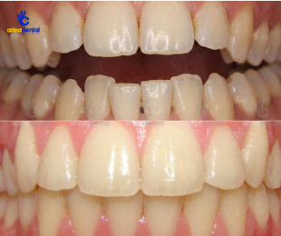 Răng sai lệch khớp cắn