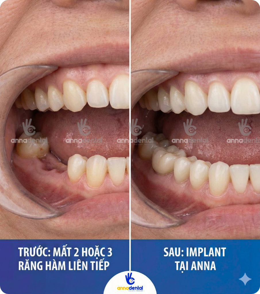 Mất 2 hoặc 3 răng hàm liên tiếp